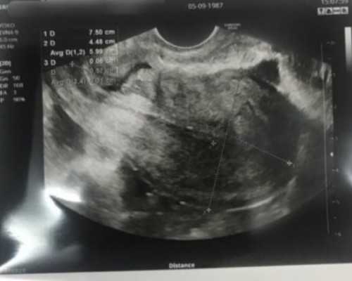 (合肥第三代)合肥三代试管包成功可以相信吗