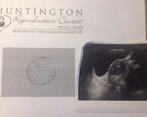 上海古玩市场排名,二尖瓣狭窄超声分度