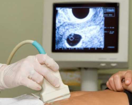 怀孕多久能查出来男女香港验血,输卵管结扎术后，做试管儿还会发生宫外孕吗