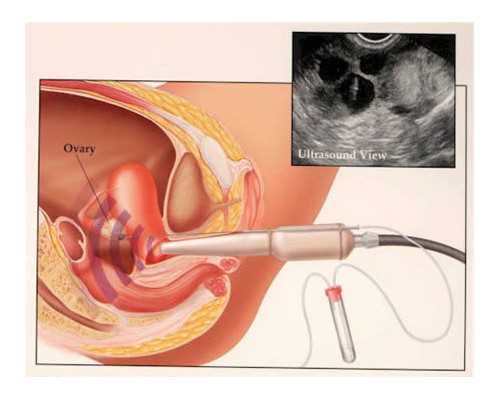 香港验血机构哪家靠谱,试管婴儿胚胎移植后，受精卵着床时有什么症状?