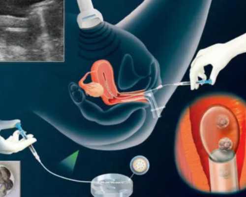 香港验血6周7周区别,女性患子宫肌瘤做试管婴儿有影响吗？