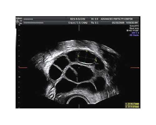 知乎香港验血费用,真实病例｜备孕二孩才发现无精子症，老大还是不是亲生的