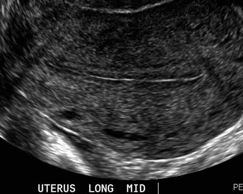 香港验血男女违法,女方不排卵能做试管婴儿吗